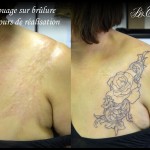 Tatouage sur brûlure